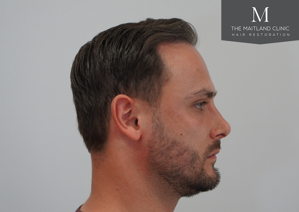 Repair surgery: FUE punch out removal of 464 hairline grafts