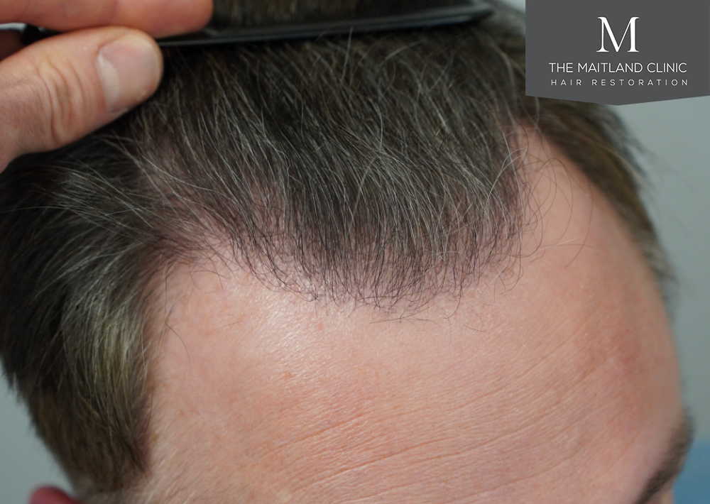 2032 grafts by FUE