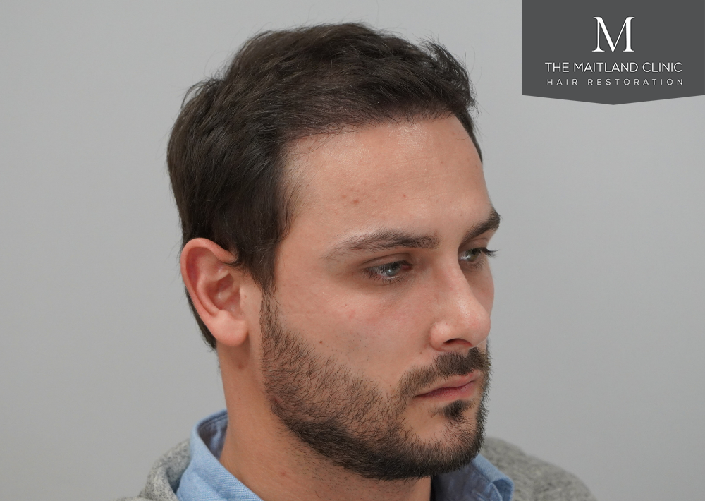 Repair surgery: FUE punch out removal of 464 hairline grafts