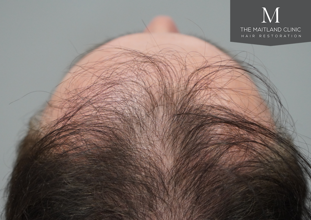 2032 grafts by FUE