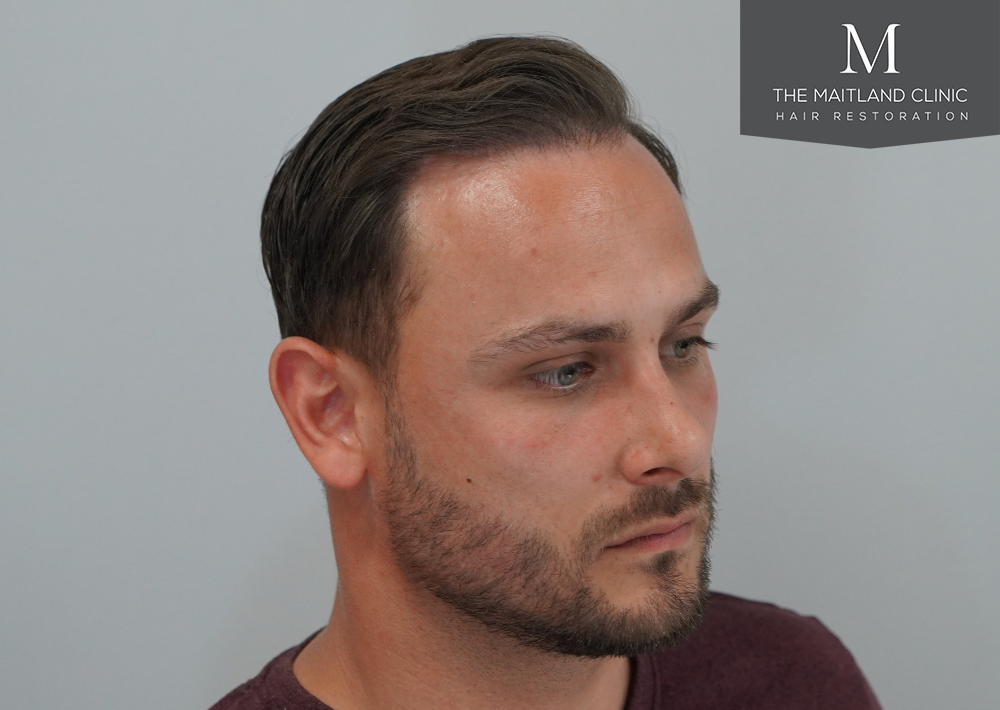 Repair surgery: FUE punch out removal of 464 hairline grafts