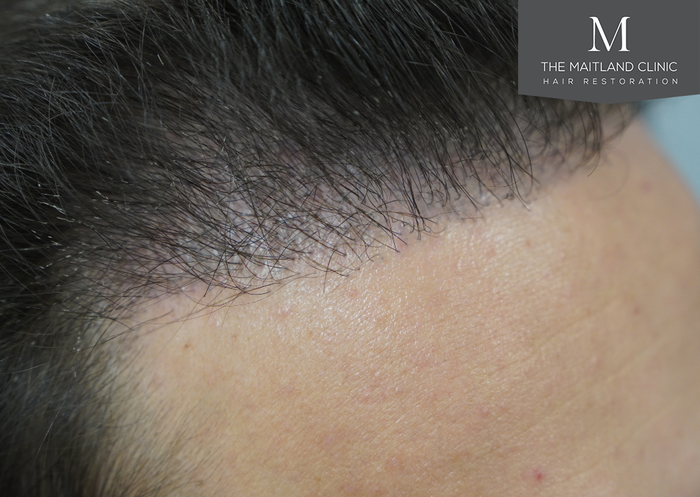 Repair surgery: FUE punch out removal of 464 hairline grafts