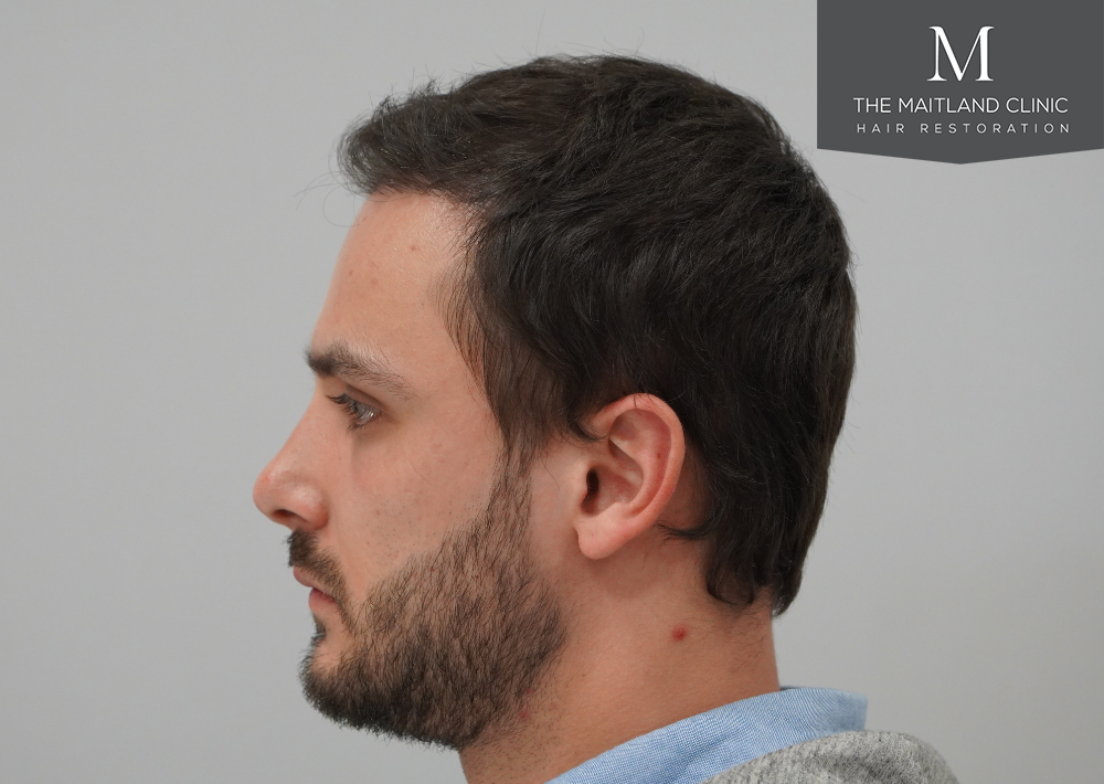 Repair surgery: FUE punch out removal of 464 hairline grafts