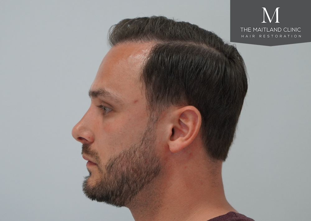 Repair surgery: FUE punch out removal of 464 hairline grafts