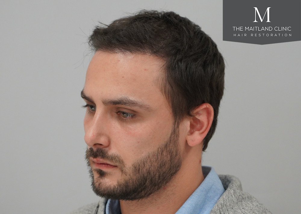 Repair surgery: FUE punch out removal of 464 hairline grafts