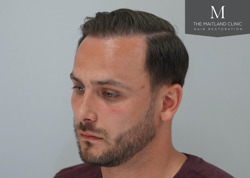 Repair surgery: FUE punch out removal of 464 hairline grafts