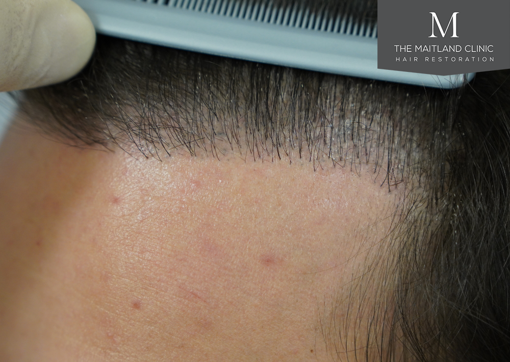 Repair surgery: FUE punch out removal of 464 hairline grafts