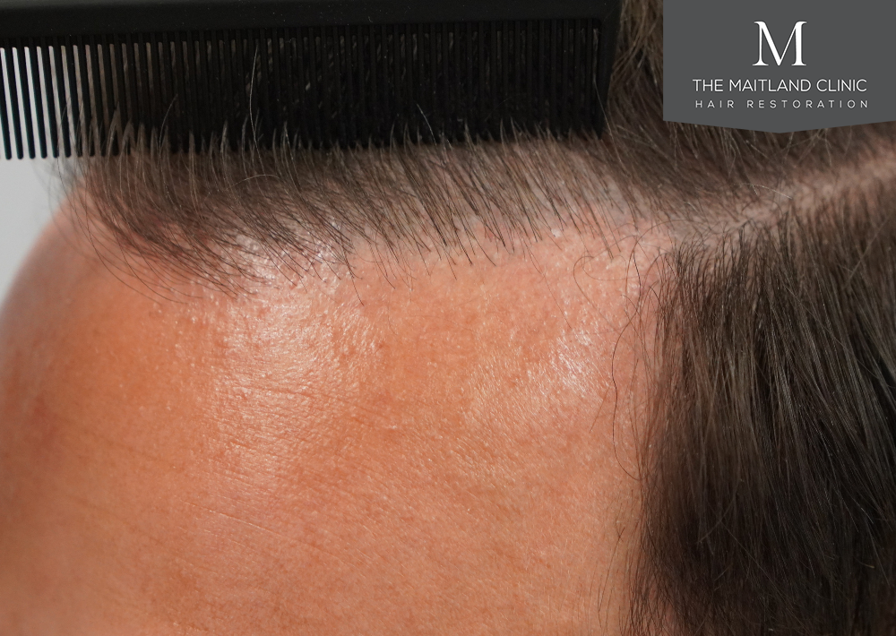 Repair surgery: FUE punch out removal of 464 hairline grafts