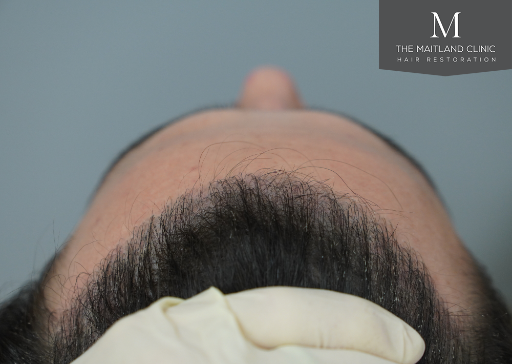 Repair surgery: FUE punch out removal of 464 hairline grafts