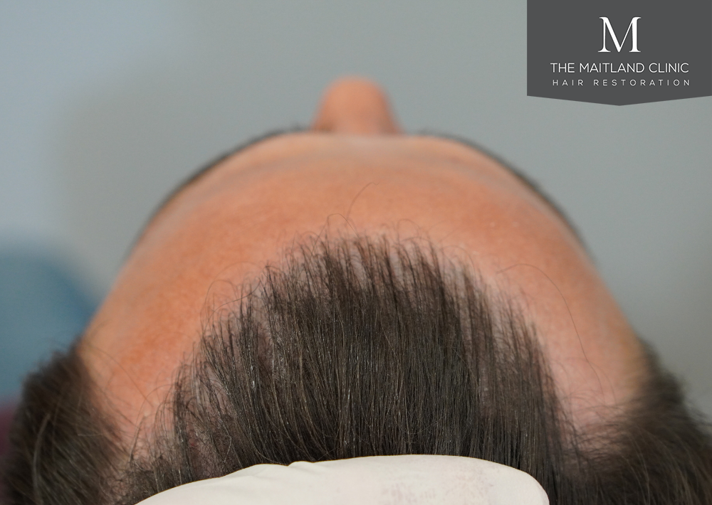Repair surgery: FUE punch out removal of 464 hairline grafts