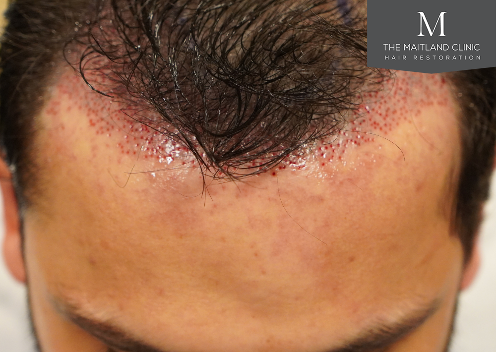 Repair surgery: FUE punch out removal of 464 hairline grafts