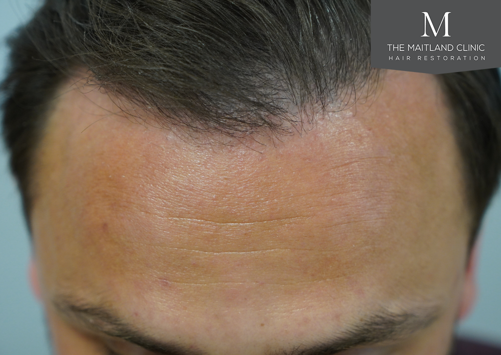 Repair surgery: FUE punch out removal of 464 hairline grafts