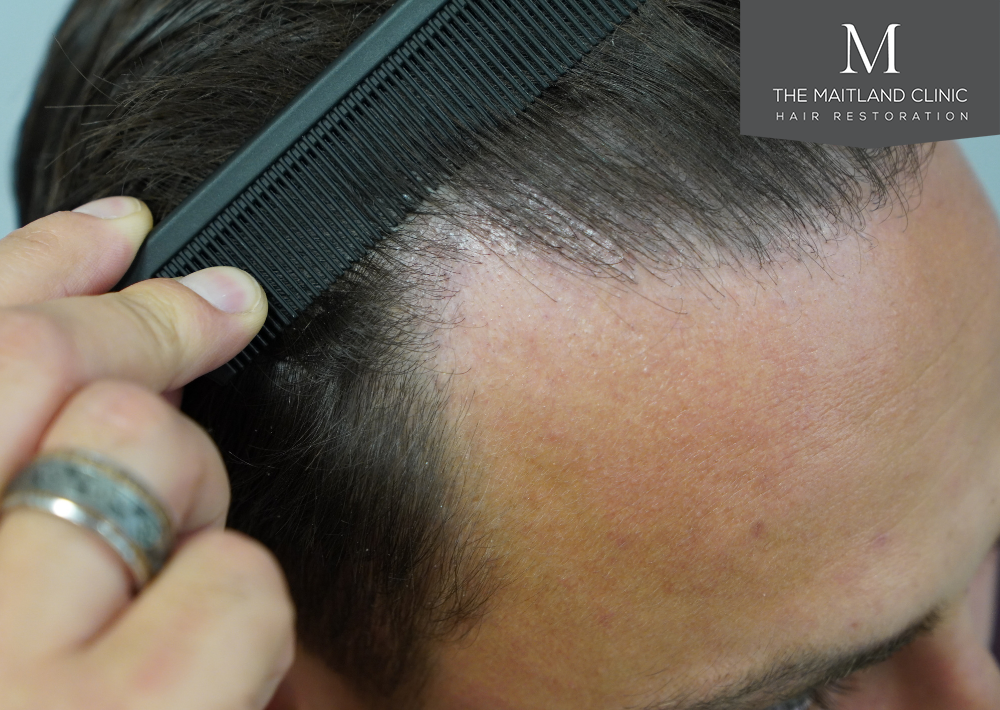 Repair surgery: FUE punch out removal of 464 hairline grafts