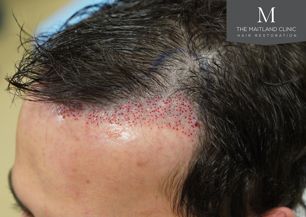 Repair surgery: FUE punch out removal of 464 hairline grafts