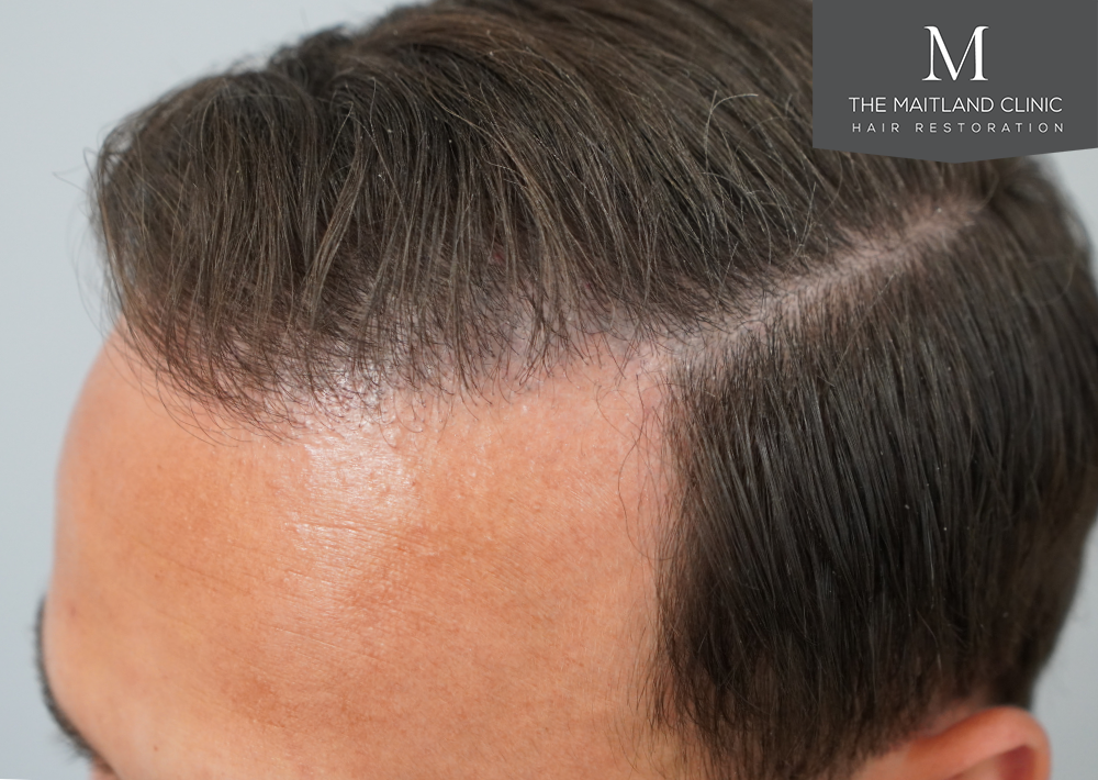 Repair surgery: FUE punch out removal of 464 hairline grafts