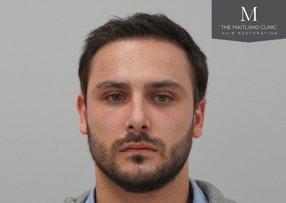 Repair surgery: FUE punch out removal of 464 hairline grafts
