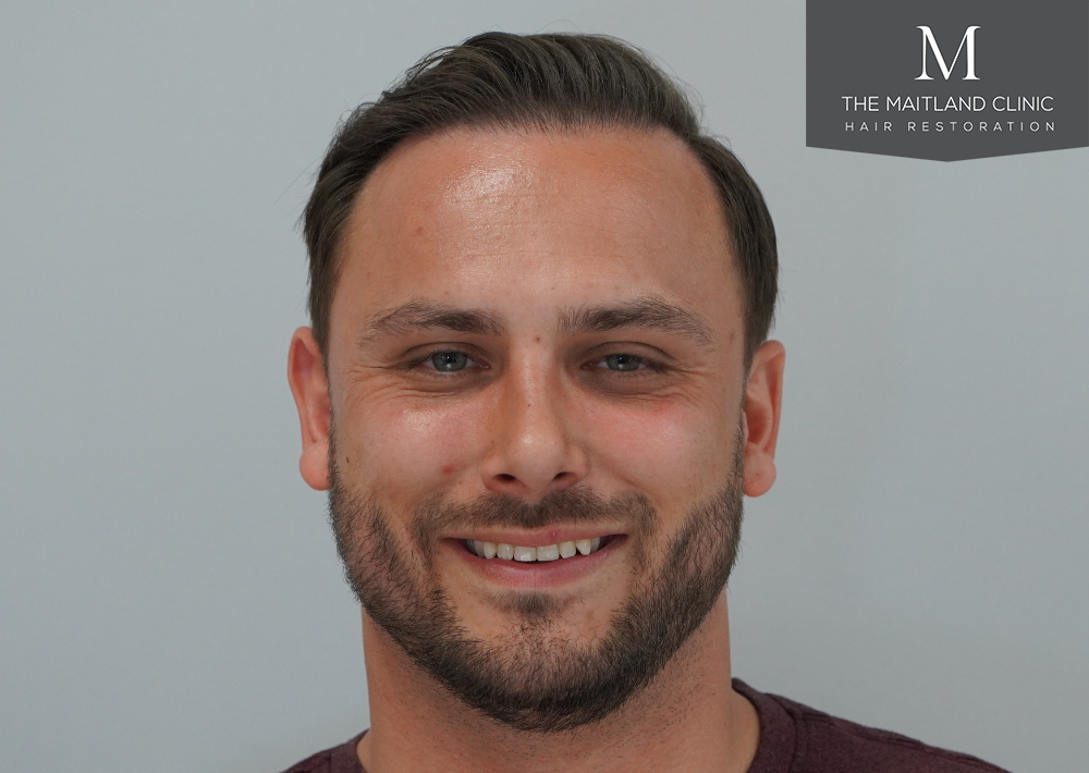 Repair surgery: FUE punch out removal of 464 hairline grafts