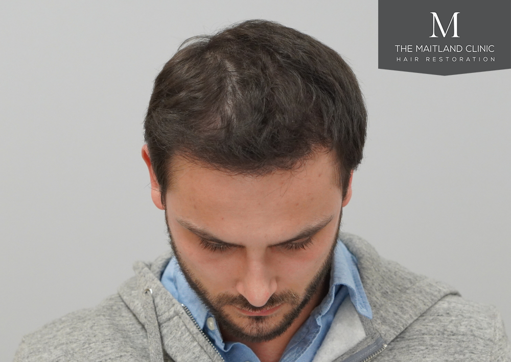 Repair surgery: FUE punch out removal of 464 hairline grafts