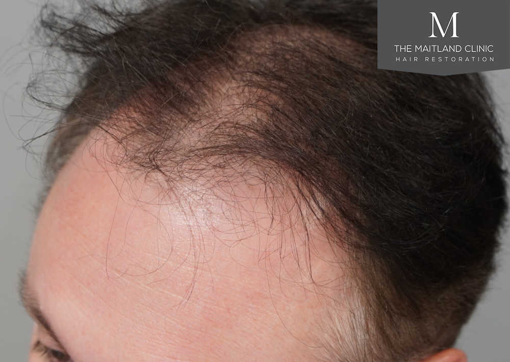 2032 grafts by FUE