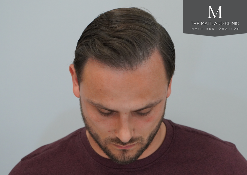 Repair surgery: FUE punch out removal of 464 hairline grafts