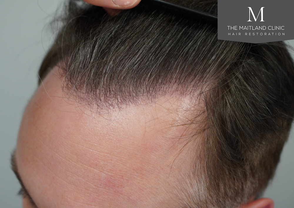 2032 grafts by FUE