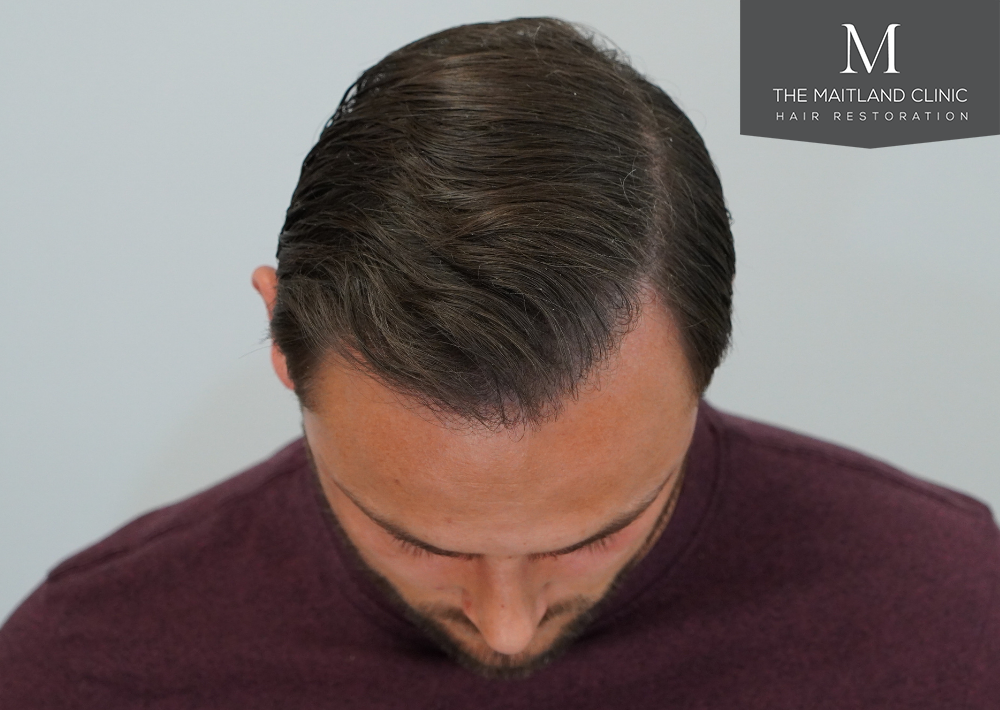 Repair surgery: FUE punch out removal of 464 hairline grafts