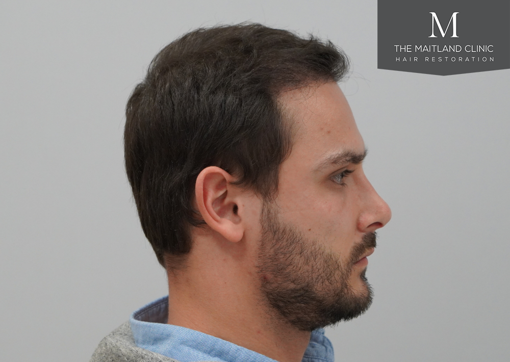 Repair surgery: FUE punch out removal of 464 hairline grafts