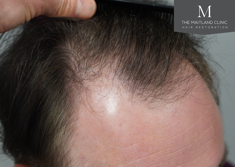 2032 grafts by FUE
