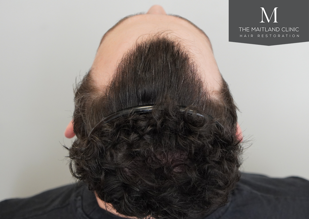 1801 grafts by FUE