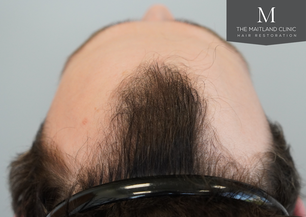 1801 grafts by FUE