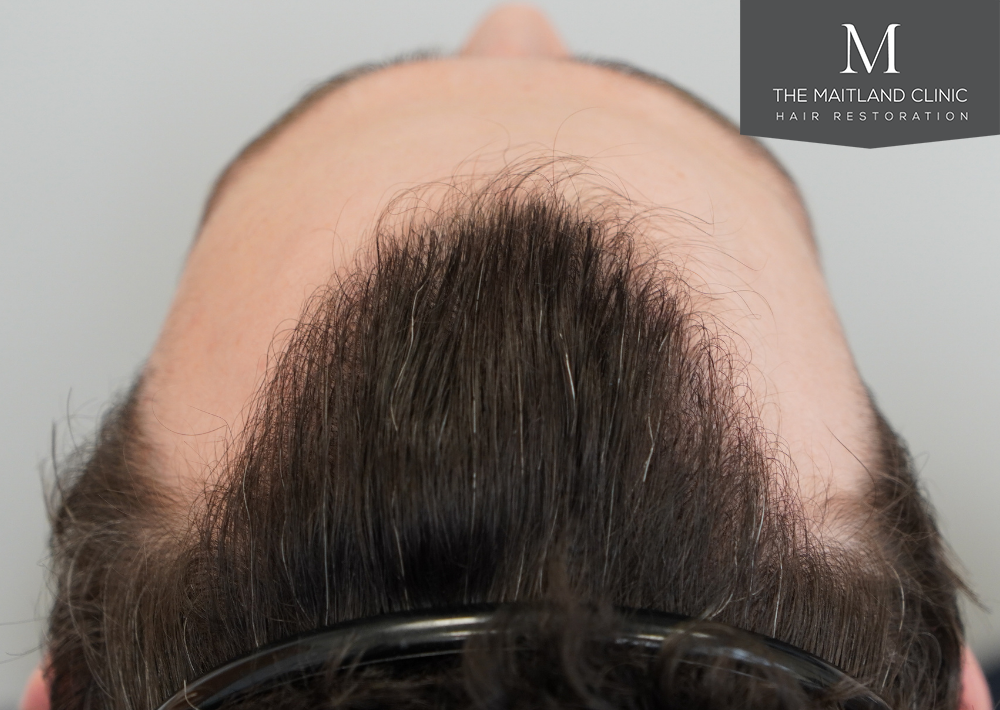 1801 grafts by FUE