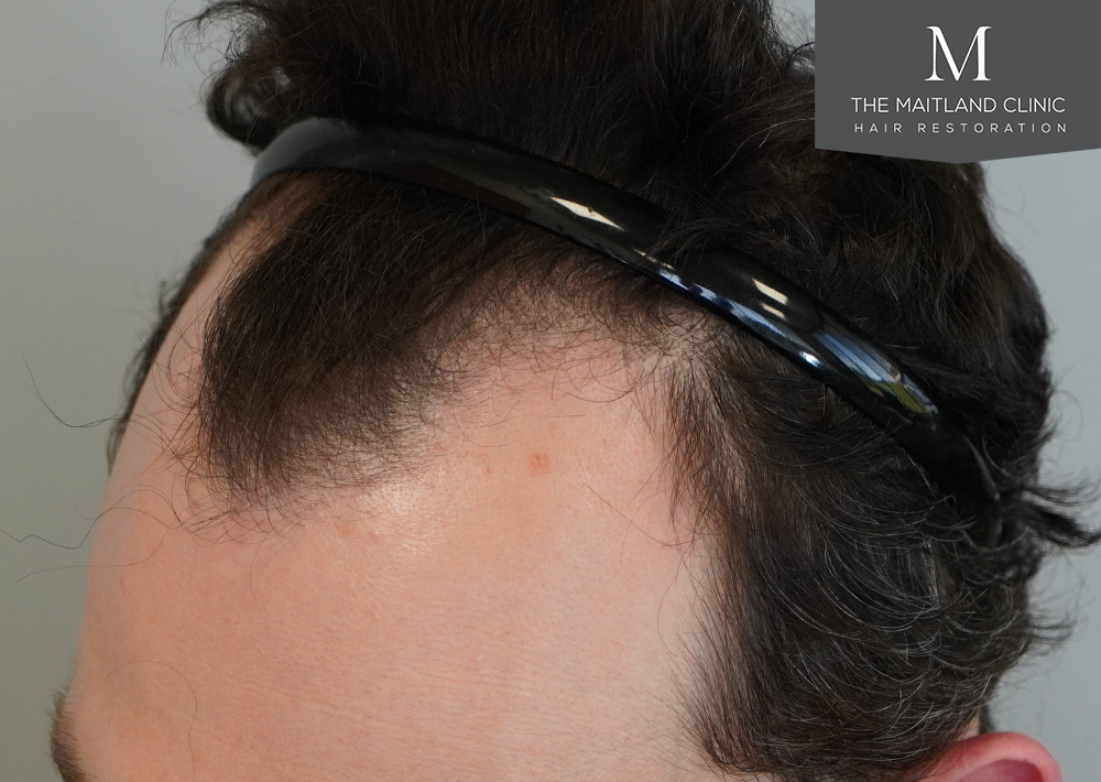 1801 grafts by FUE