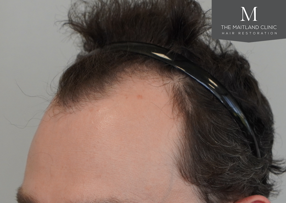 1801 grafts by FUE