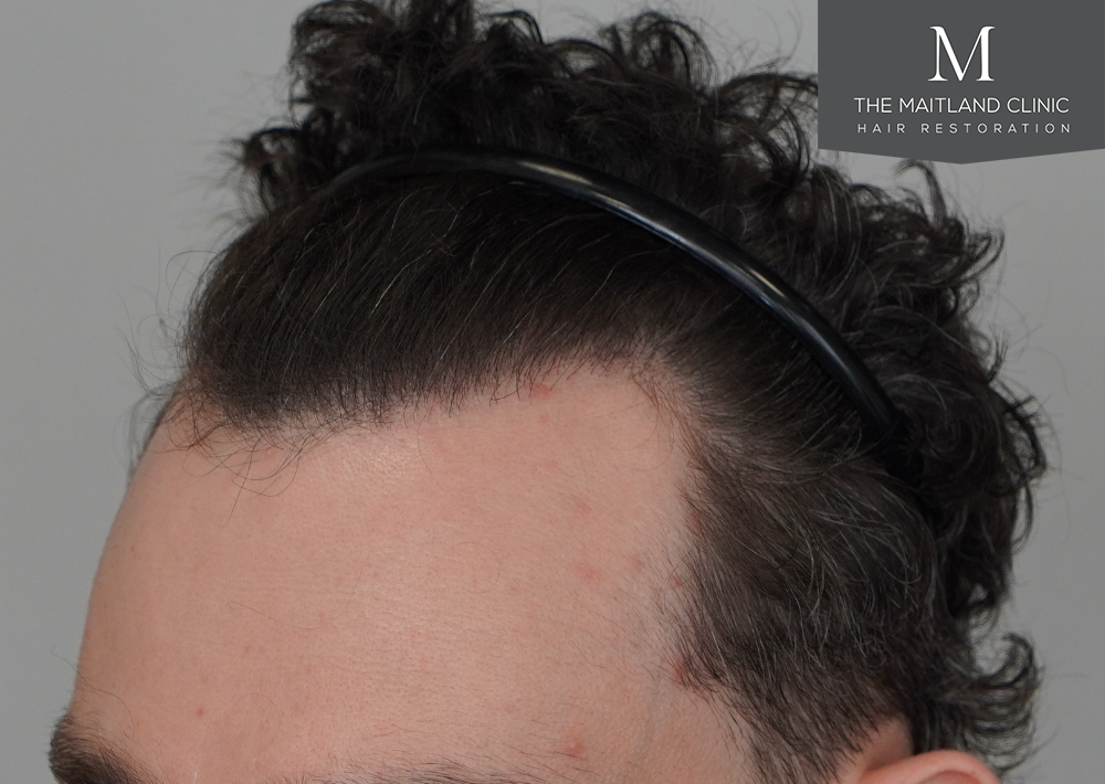 1801 grafts by FUE