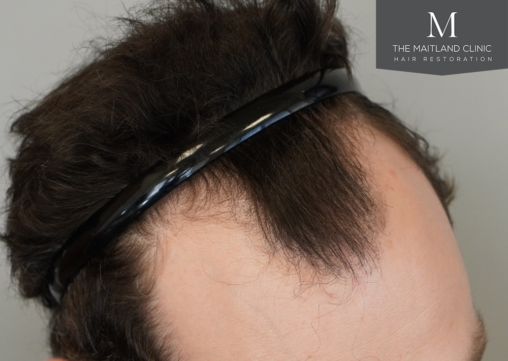 1801 grafts by FUE