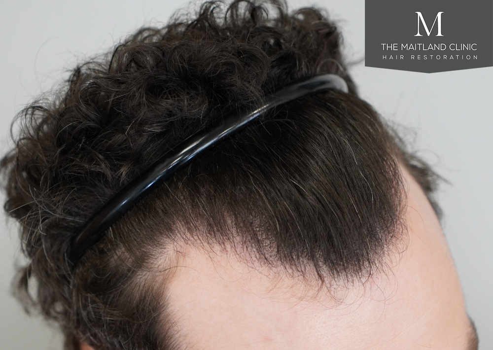 1801 grafts by FUE