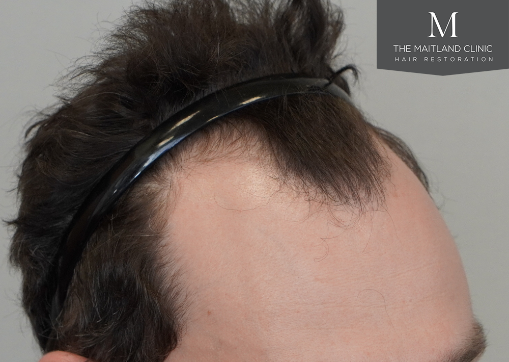 1801 grafts by FUE