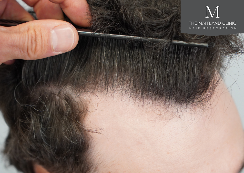 1801 grafts by FUE