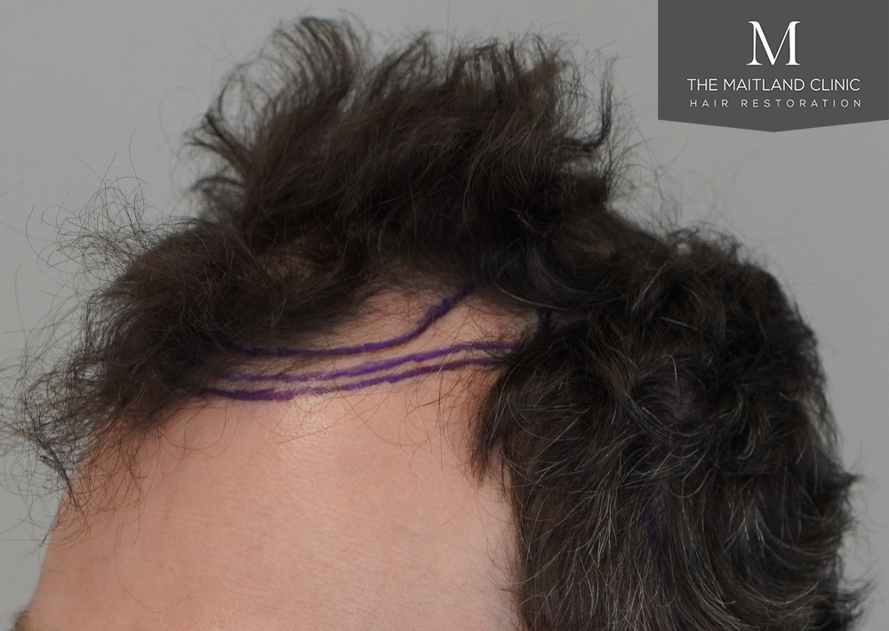 1801 grafts by FUE