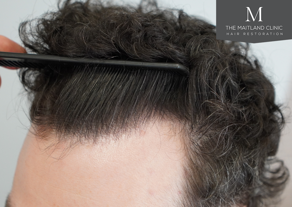 1801 grafts by FUE
