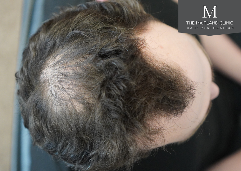 1801 grafts by FUE
