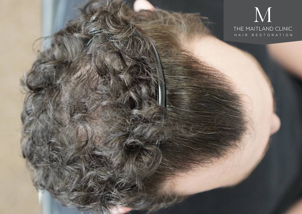 1801 grafts by FUE