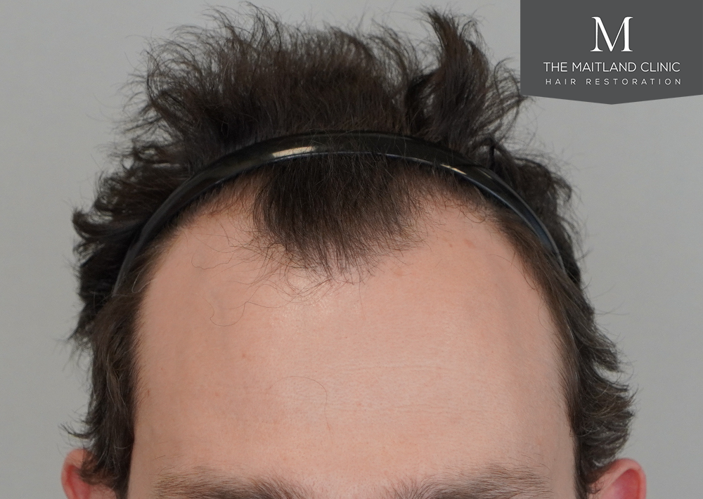 1801 grafts by FUE
