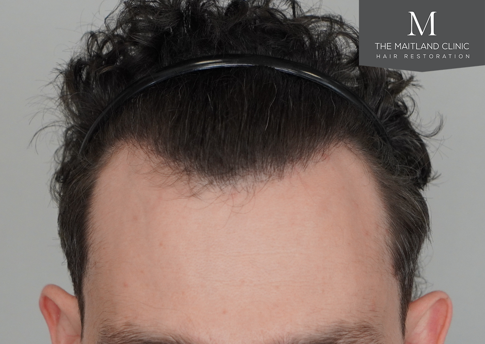 1801 grafts by FUE