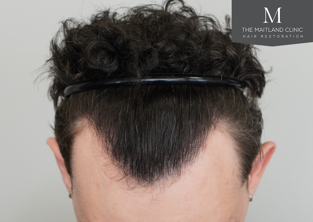 1801 grafts by FUE