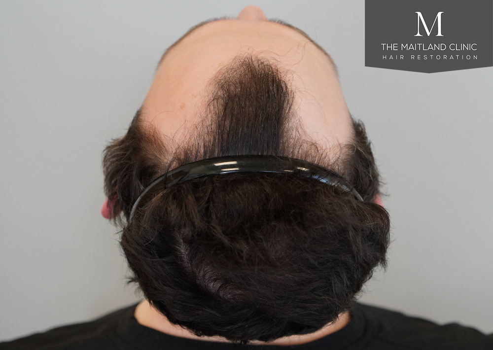 1801 grafts by FUE