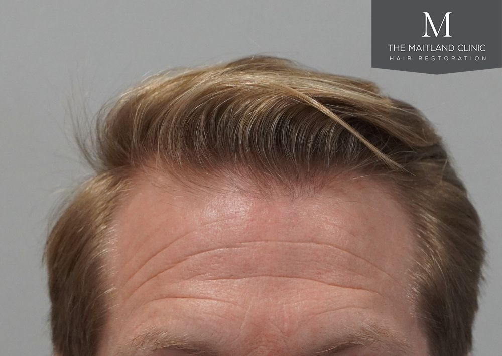 1956 grafts by FUE