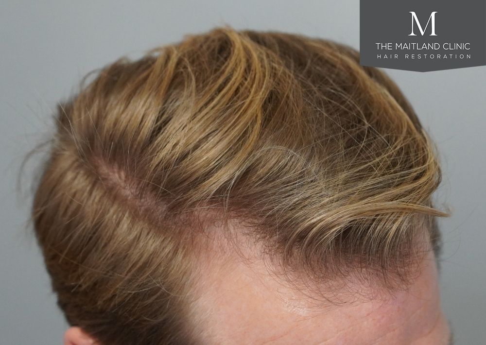 1956 grafts by FUE
