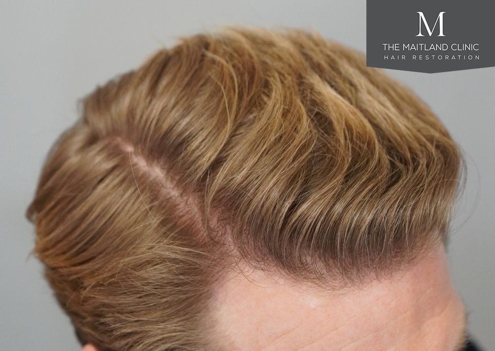1956 grafts by FUE