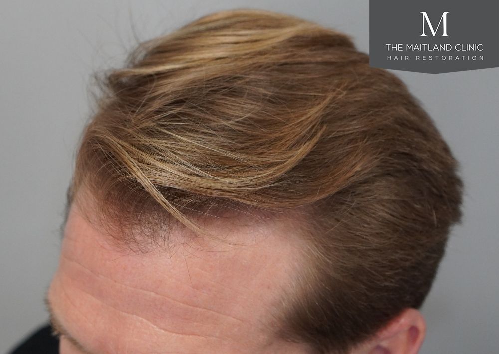 1956 grafts by FUE